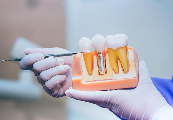 Dentist pointing to a dental implant model