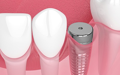 Digital illustration of a dental implant