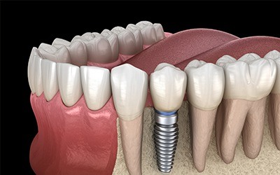 Illustrated dental crown over a dental implant in the lower jaw