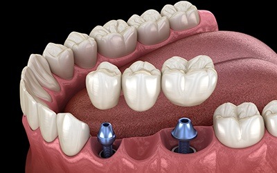 Illustrated dental bridge being placed onto two dental implants