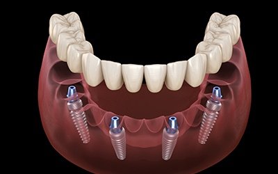 Illustrated full denture being placed onto six dental implants