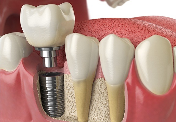 Illustrated dental implant in lower jawbone