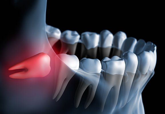 Illustrated impacted wisdom tooth pressing against back molar