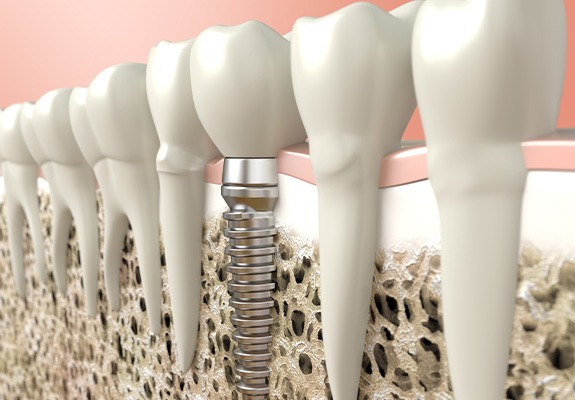 Digital illustration of a dental implant