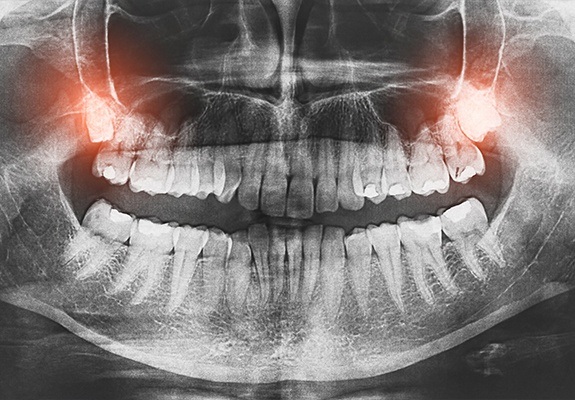 X ray of mouth with impacted wisdom teeth highlighted