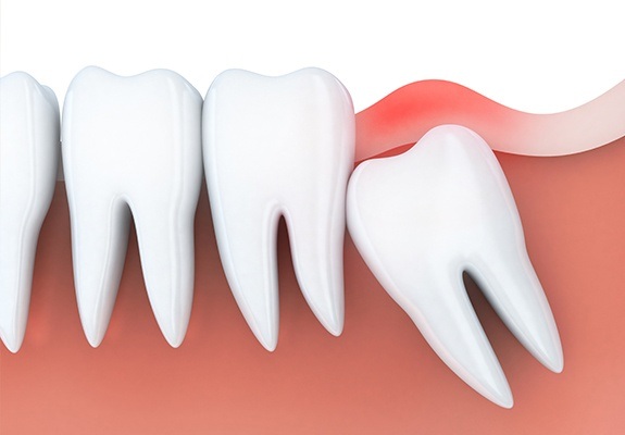 Illustration of impacted wisdom tooth pressing against adjacent tooth