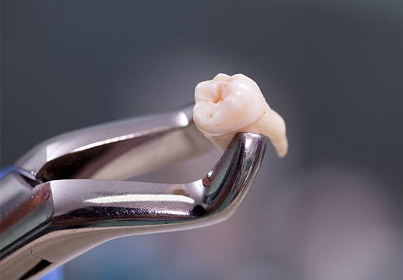 Metal clasp holding extracted wisdom tooth