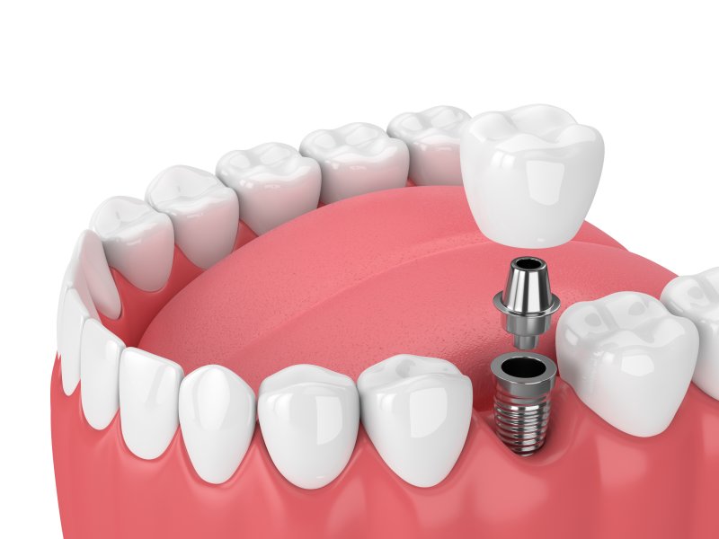 Illustration of dental implants in Washington, DC