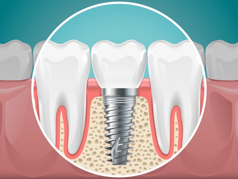 Illustration of healthy dental implant