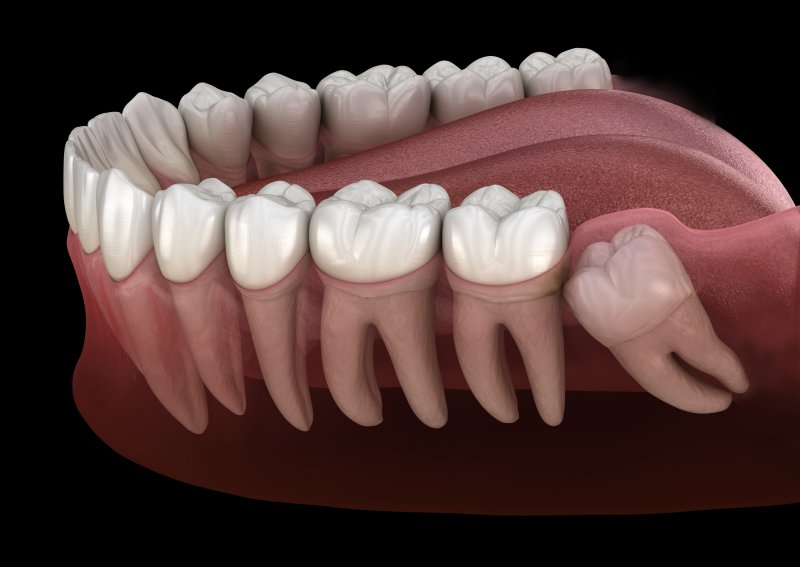 Impacted wisdom tooth